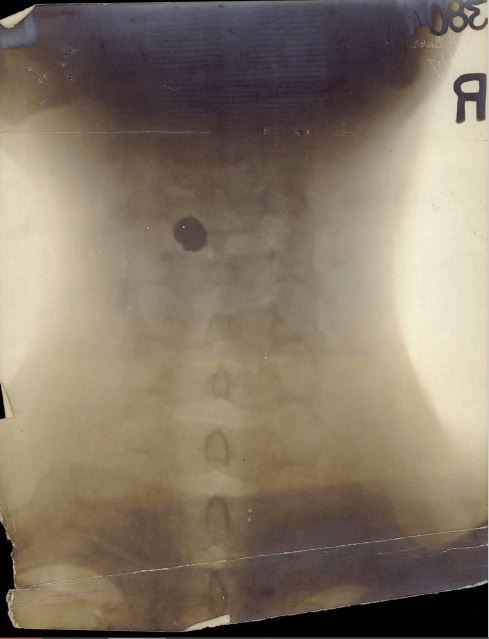 John Henry Burr xray of neck and bullet