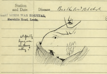 Detail of medical sketch adjacent to notes in Private A.E. Blue's medical file.